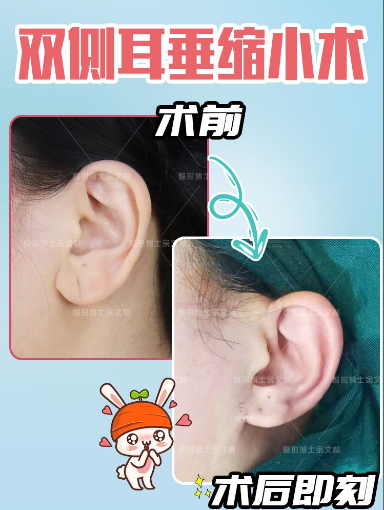 也有人可能完全没有耳垂.手术可利用耳后乳突区皮瓣,外形设计是重点.