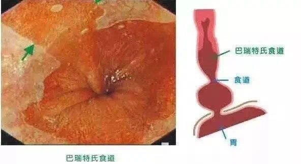 巴雷特食管全周型图片