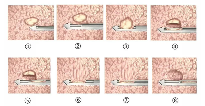 乳腺良性结节的热消融联合微创旋切术是什么？