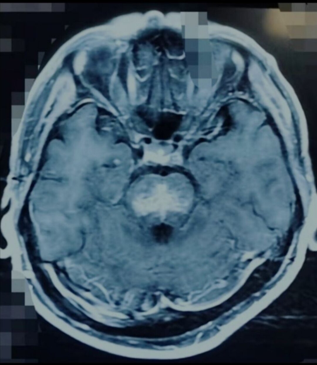 脑干胶质瘤的影像表现 - 好大夫在线