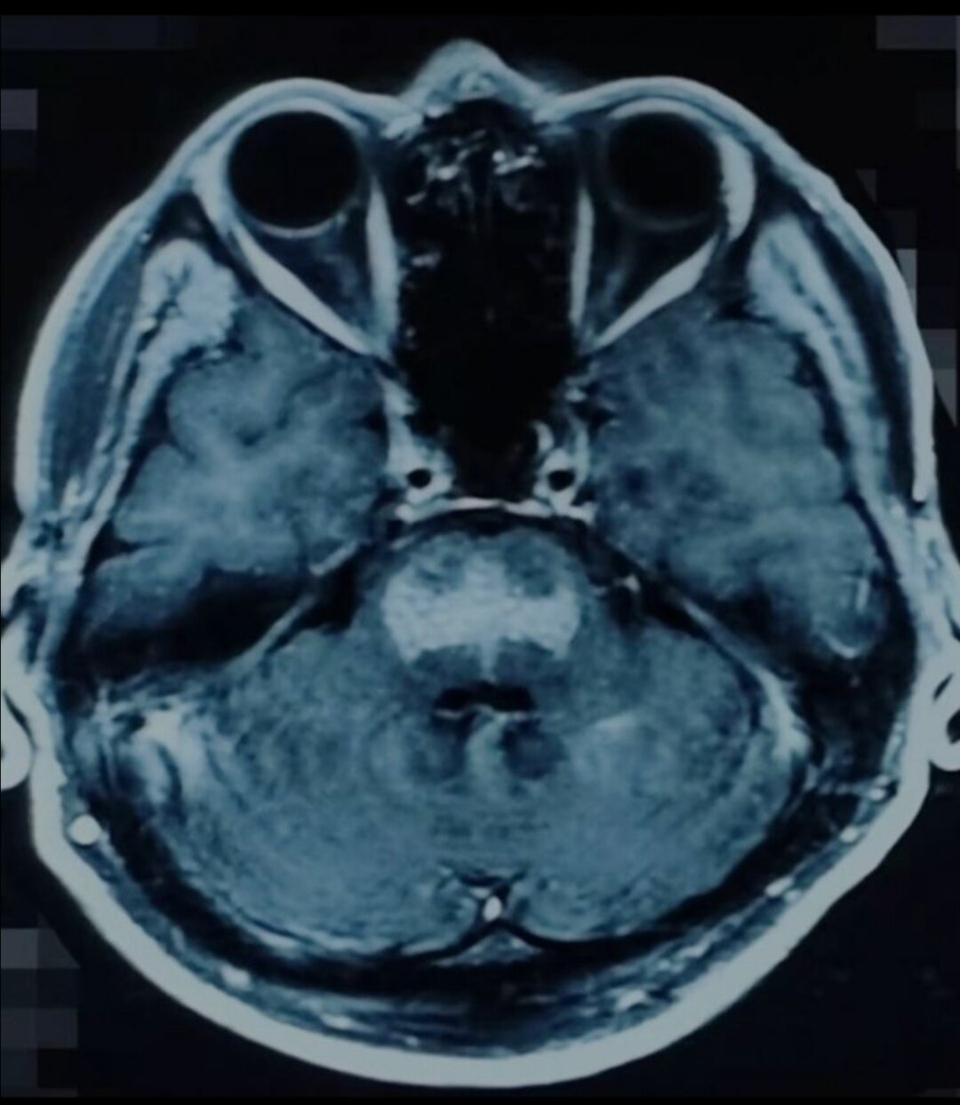 脑干胶质瘤的影像表现 - 好大夫在线