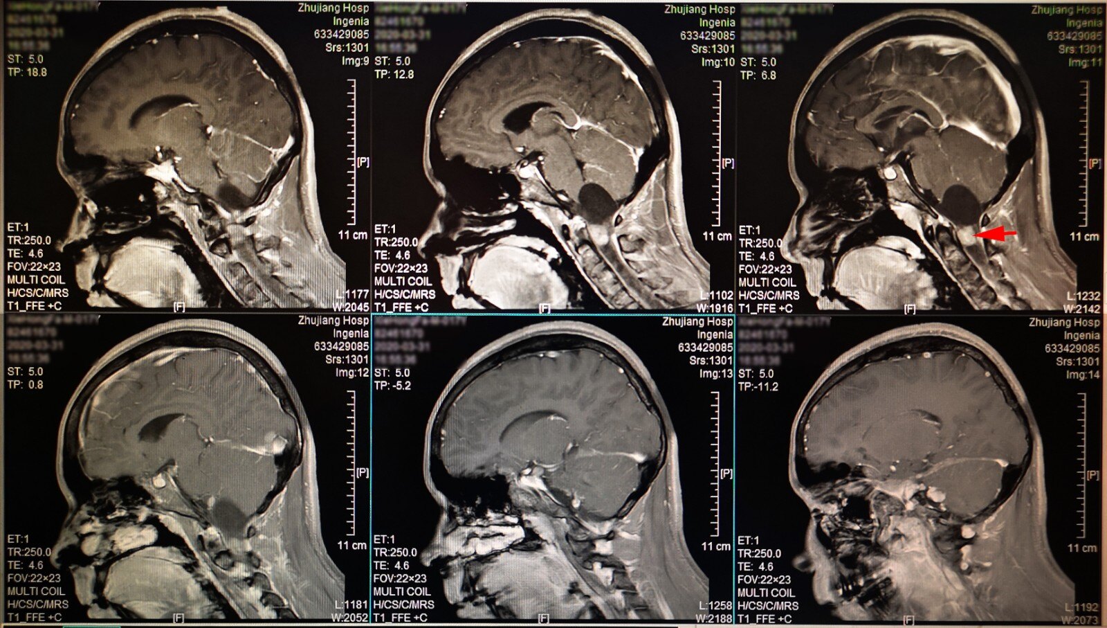 一例Ⅱ型神经纤维瘤病患者的5次手术治疗(一) 