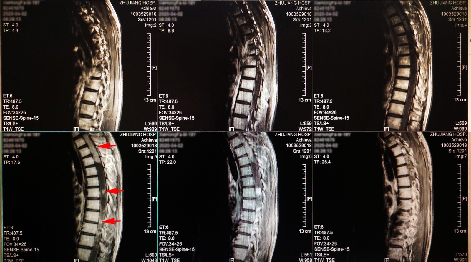 一例Ⅱ型神经纤维瘤病患者的5次手术治疗(一) - 好大夫在线