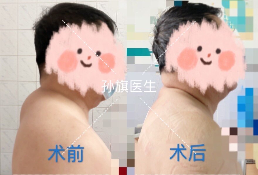 脂肪瘤_病因_症状_手术_发病原因_症状表现_治疗方式 - 好大夫在线