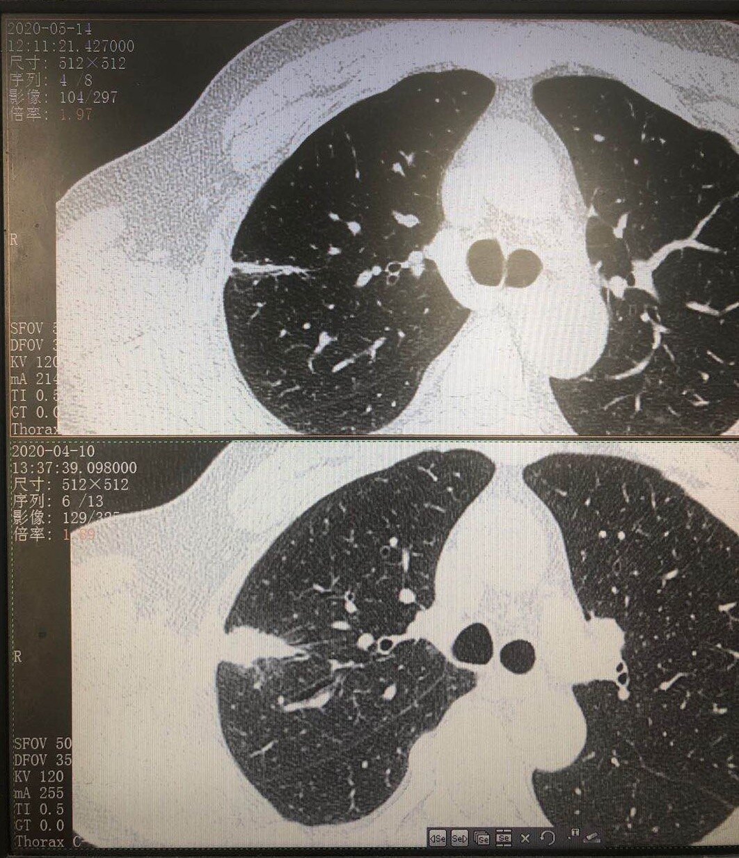 肺部结节_介绍_就诊指导 - 好大夫在线