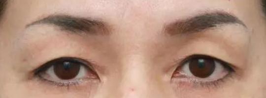 假性上睑下垂教你判断你是否眼睑下垂_上睑下垂_上睑下垂症状表现