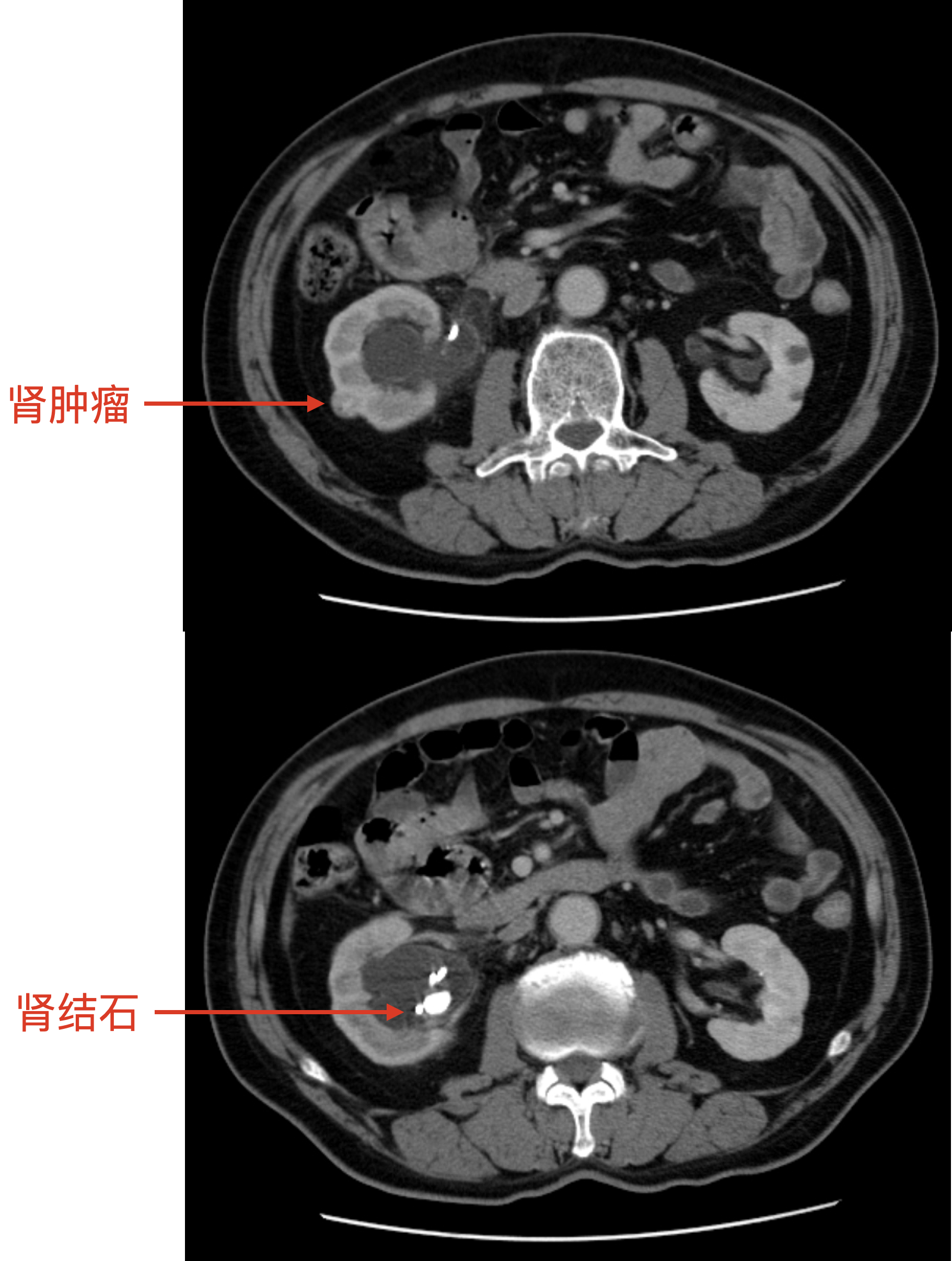 肾肿瘤合并 !