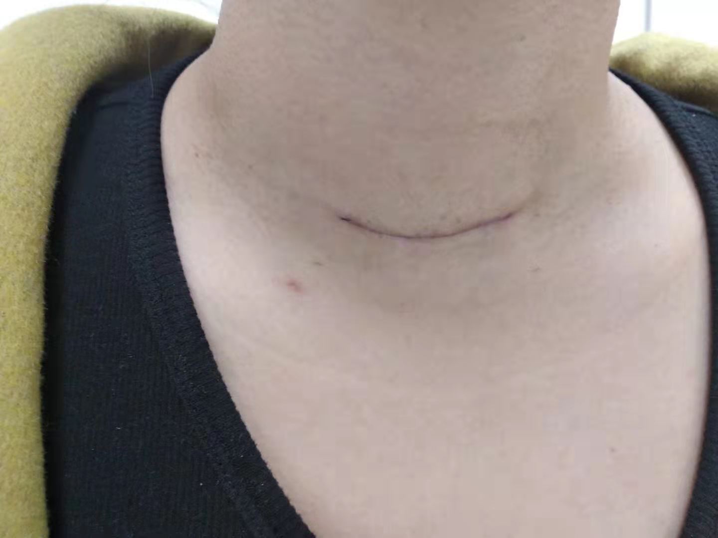 甲状腺结节手术刀口图片