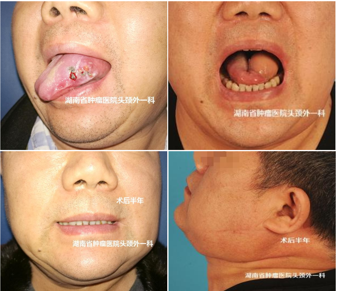 口腔癌手术过程图解图片