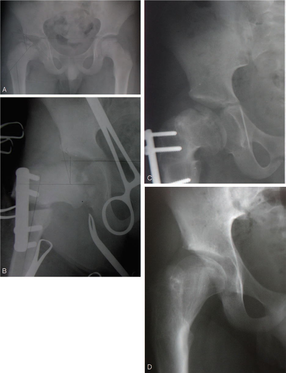 股骨内翻截骨术治疗perthes病的长期随访结果,以及开放式和闭合式楔形