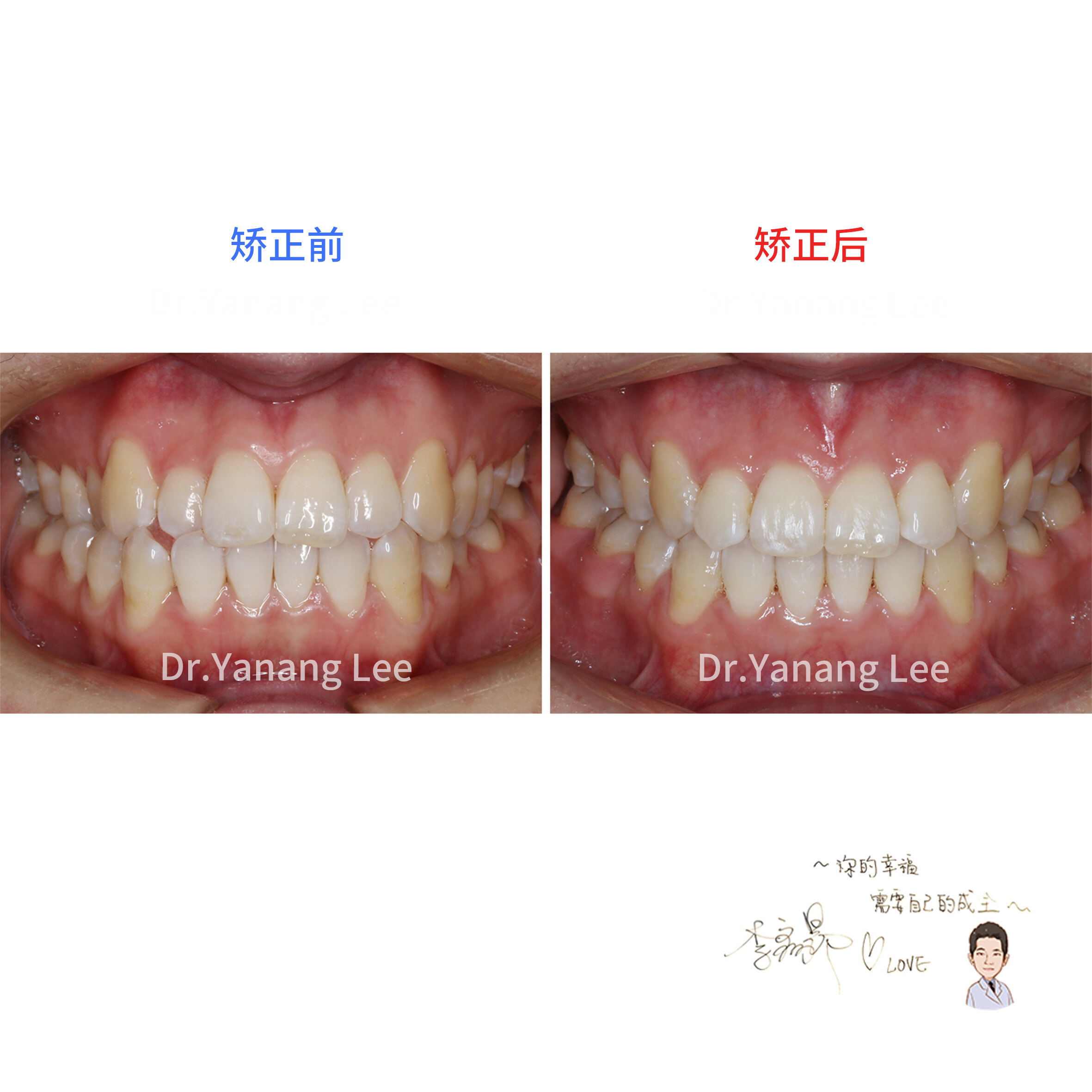 【前牙对刃,侧切牙反颌矫正案例】