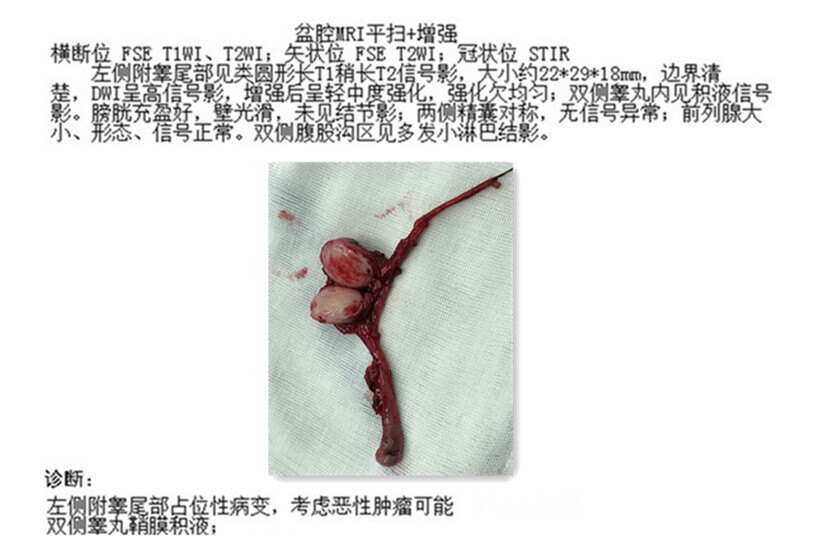 阴囊肉瘤图片图片