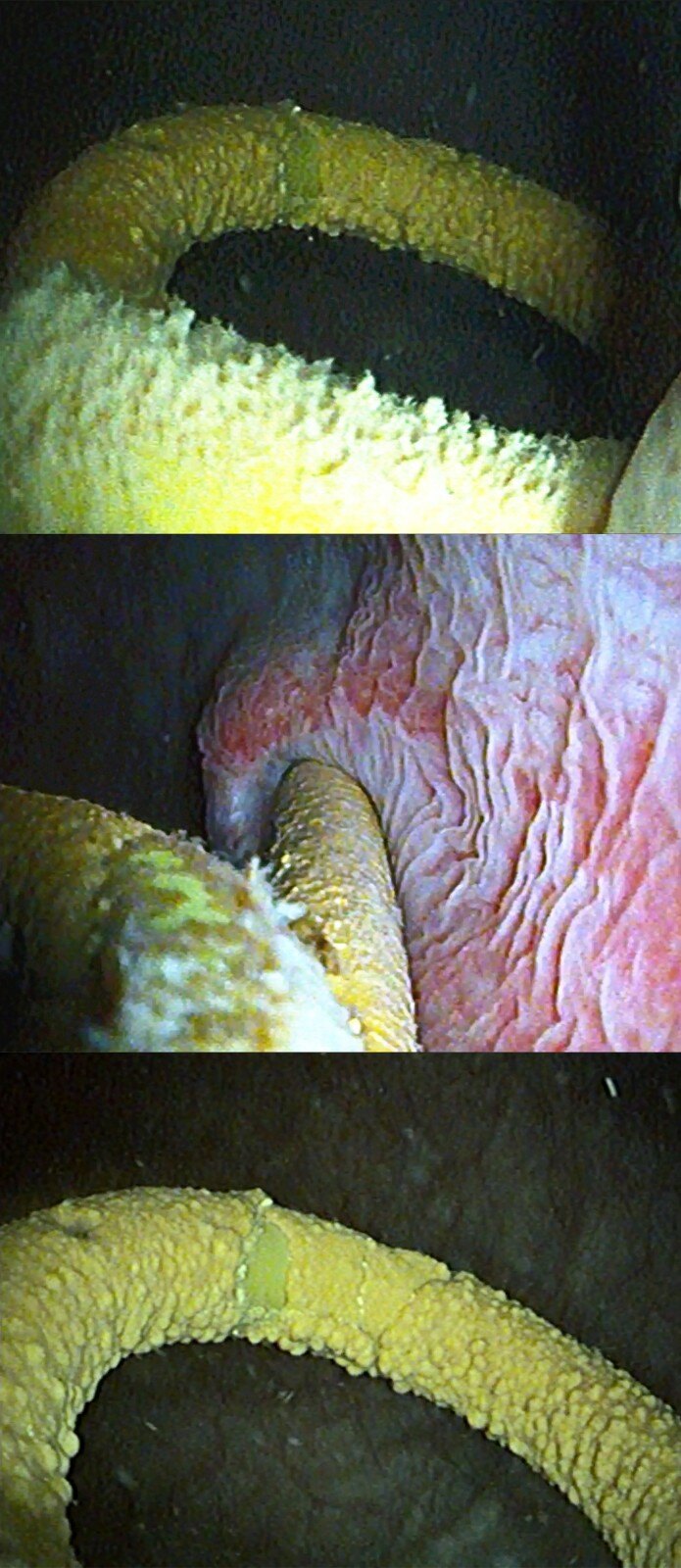 尿路结石的保守治疗和预防 - 好大夫在线