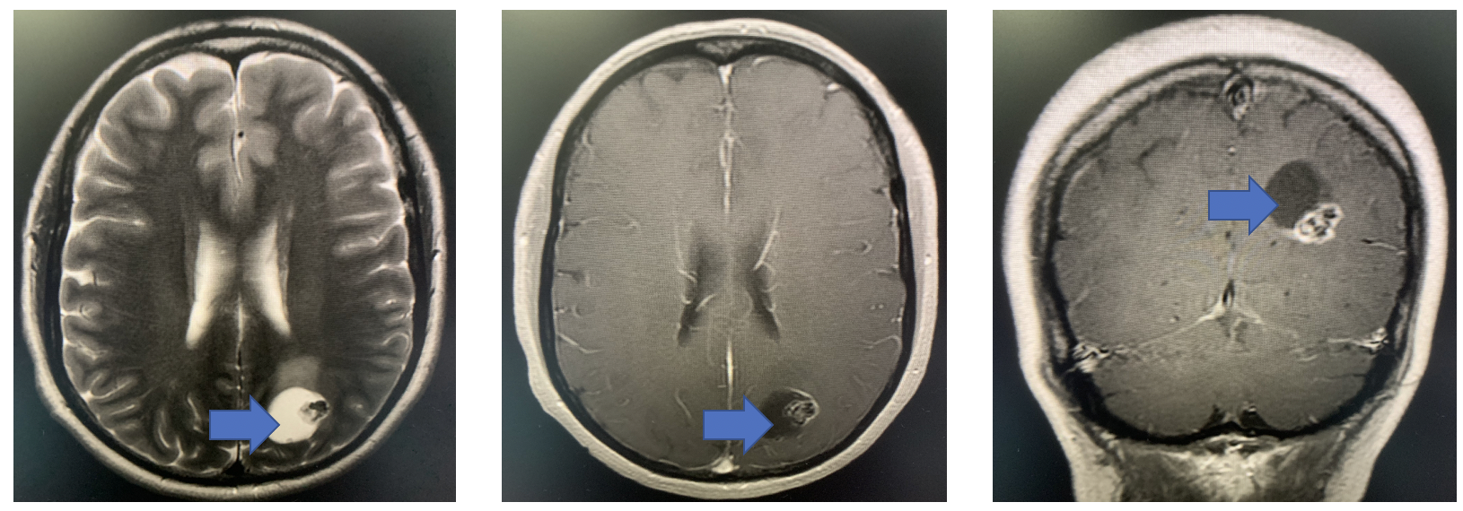 可单纯手术治愈的毛细胞星形细胞瘤不是所有胶质瘤都要放化疗