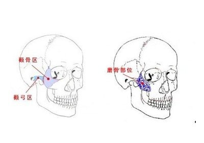 颊骨和颧骨的区别图片图片