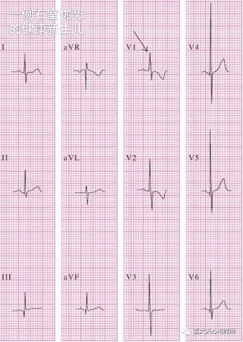右心室心电图导联定位图片