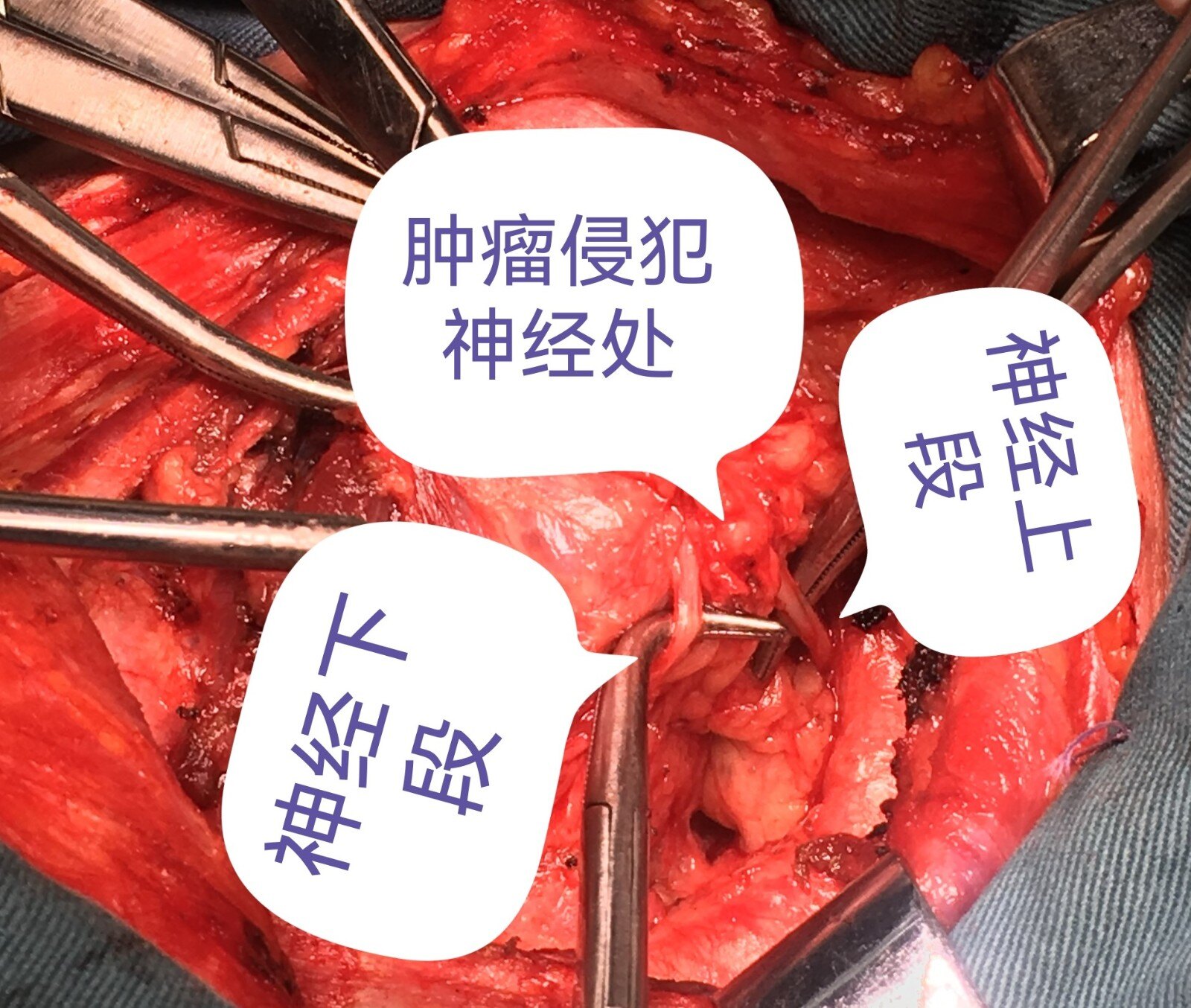 喉返神经侵犯是什么样子的 - 好大夫在线