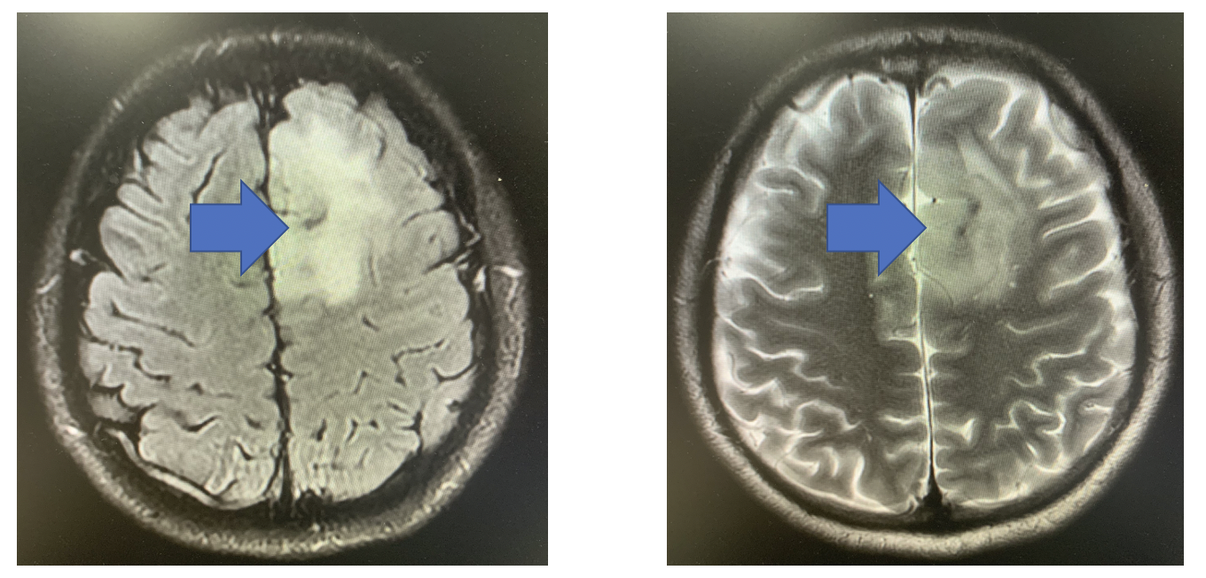 mri发现脑低级别胶质瘤怎么办,症状不严重还需要治疗吗_胶质瘤_介绍