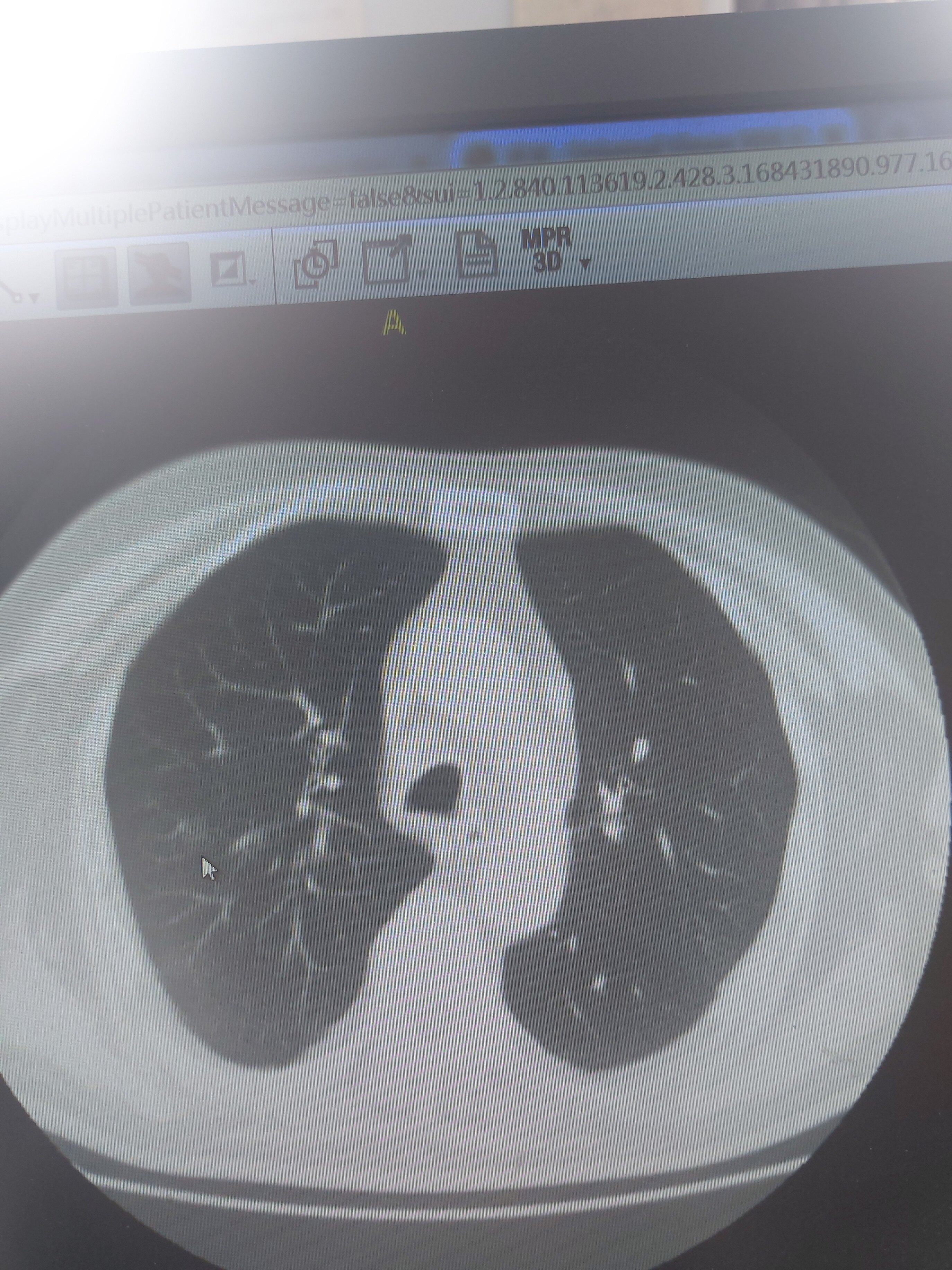 刘懿博士说肺癌 二一一一 做肠息肉,拍胸部ct发现了肺占位