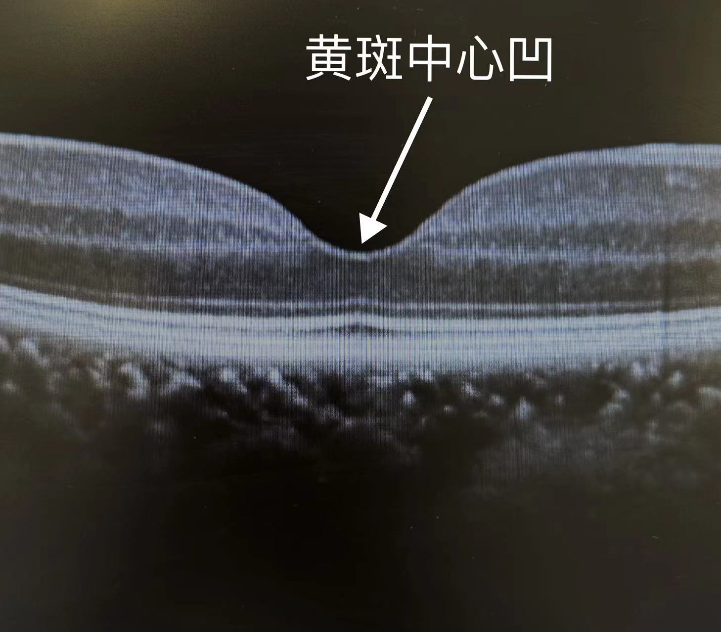 视物变形——警惕眼底黄斑变性!_黄斑变性_介绍_症状表现_检查 - 好大夫在线