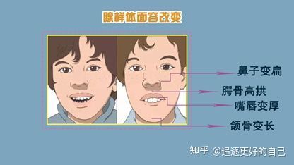 腺样体面容 对比图片