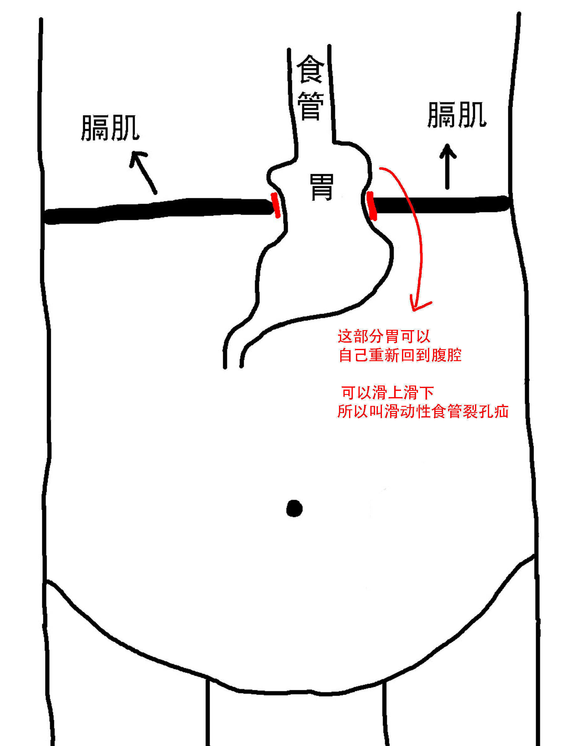 I型食管裂孔疝.jpg