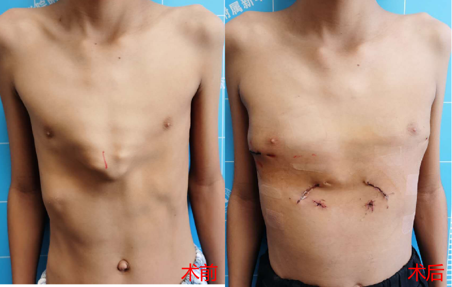复杂鸡胸的手术治疗_鸡胸_鸡胸治疗方式 - 好大夫在线