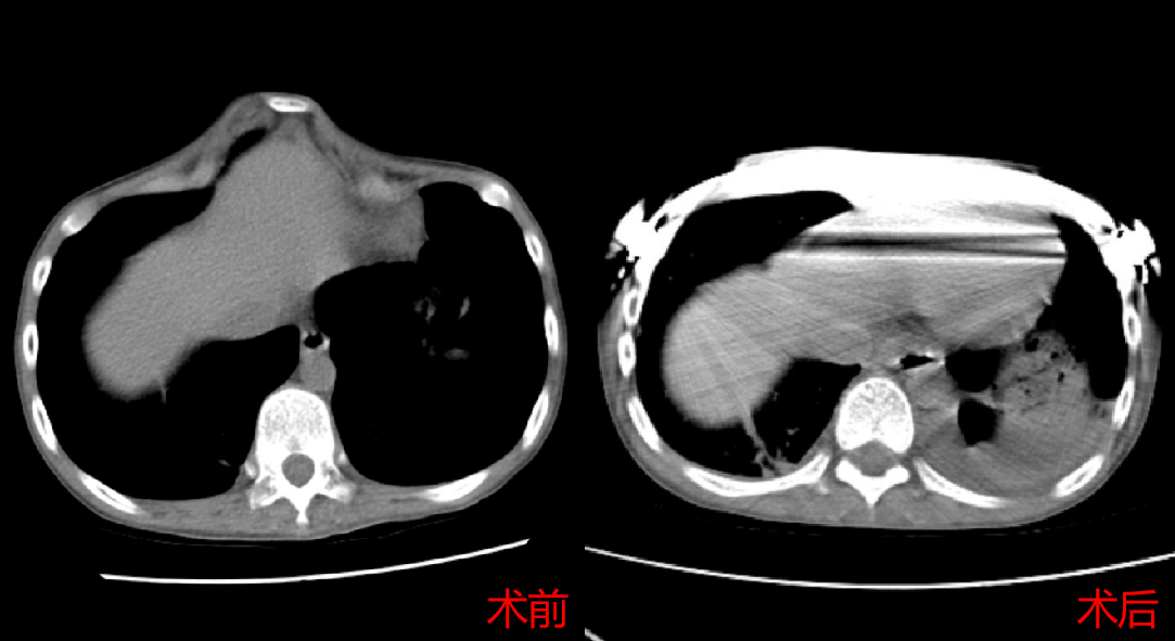 该患者是一例非常复杂的鸡胸,我们设计了复合手术方案,采用微创手术