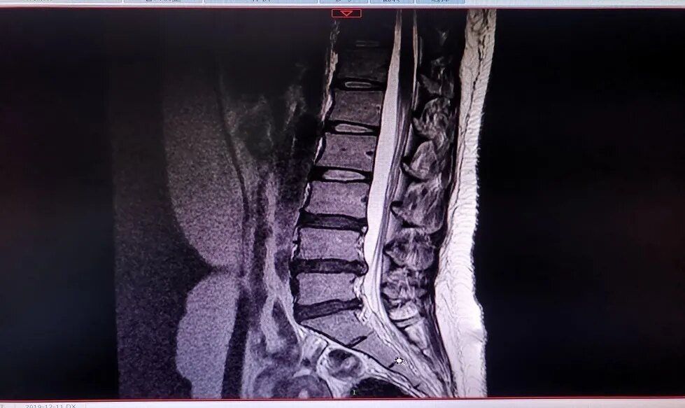 不一樣的腰痛不一樣的治療