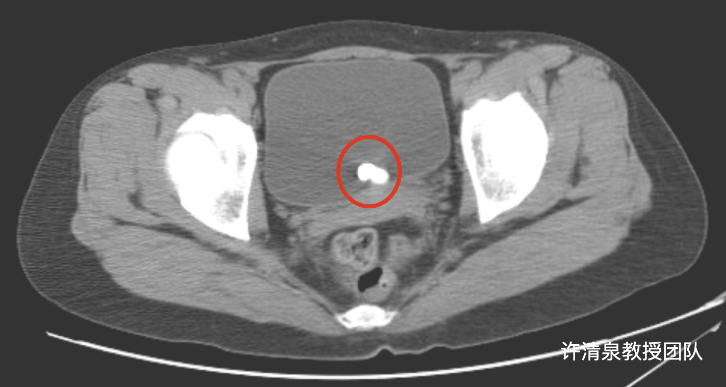 膀胱结石CT图片