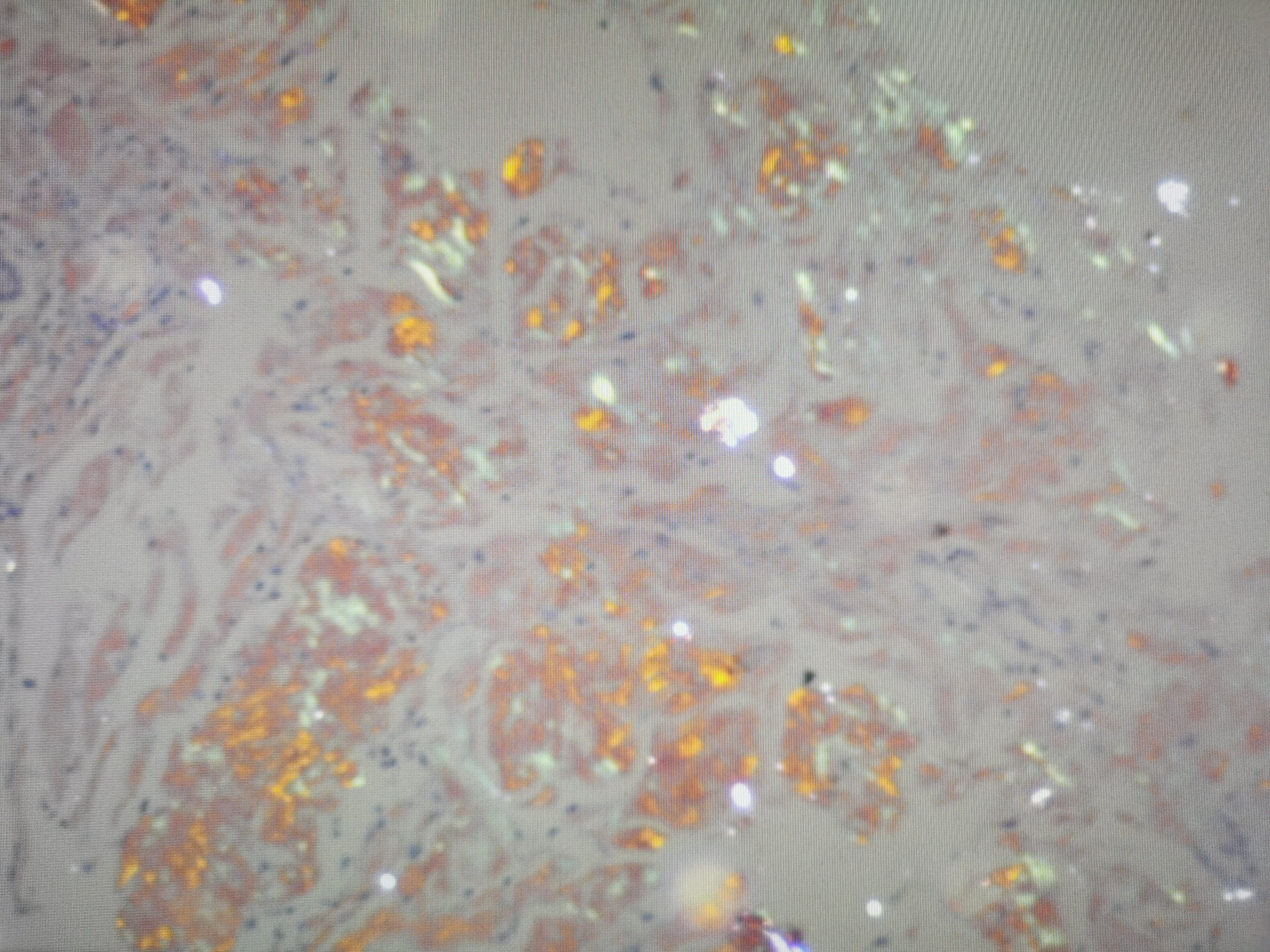 胃黏膜的淀粉样变 - 好大夫在线