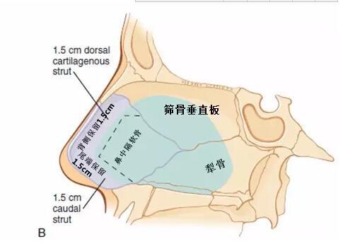为什么现在都不建议用鼻中隔软骨作为隆鼻的材料?