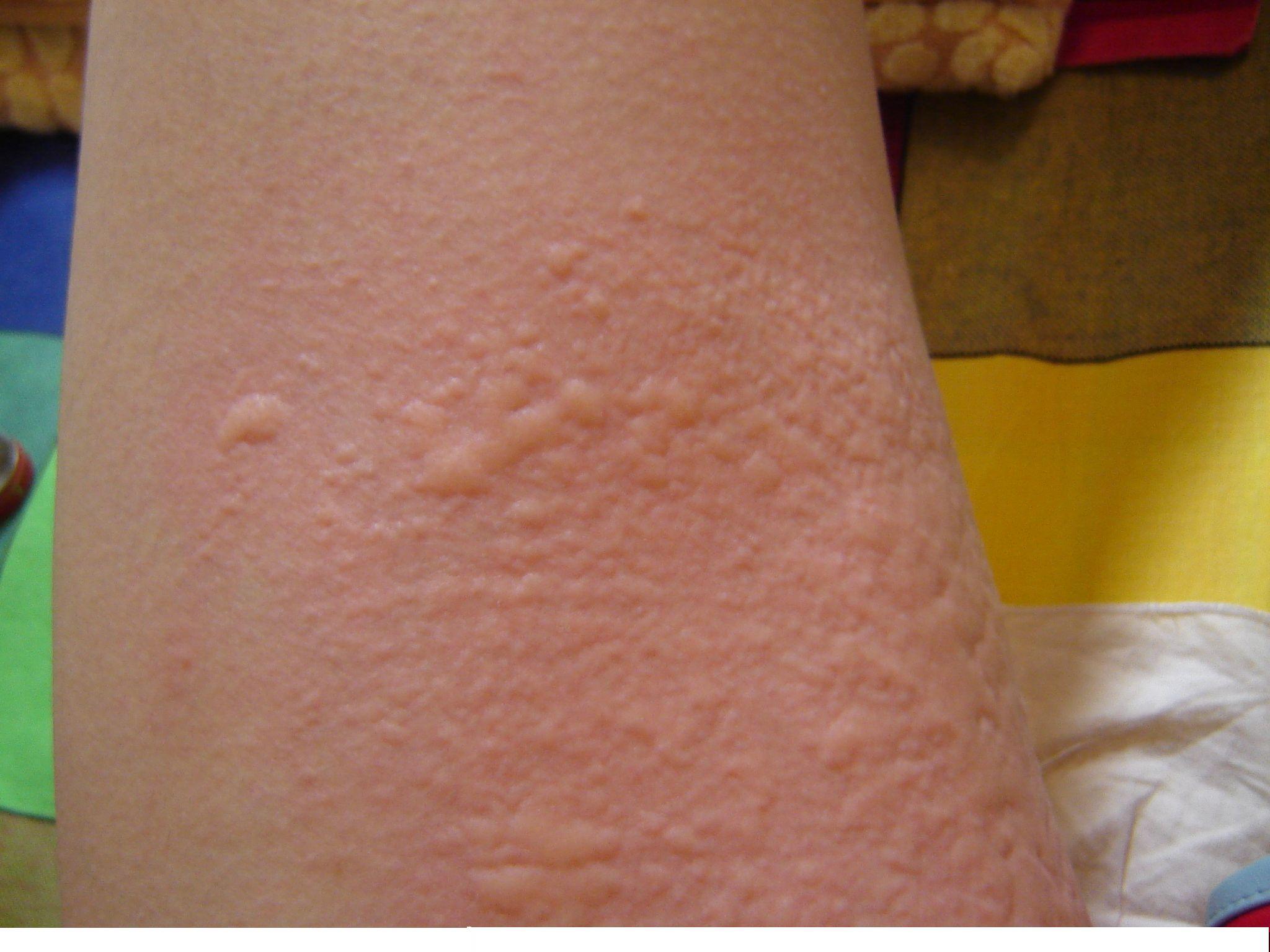 注意!!冬至过后,这些皮肤病高发!