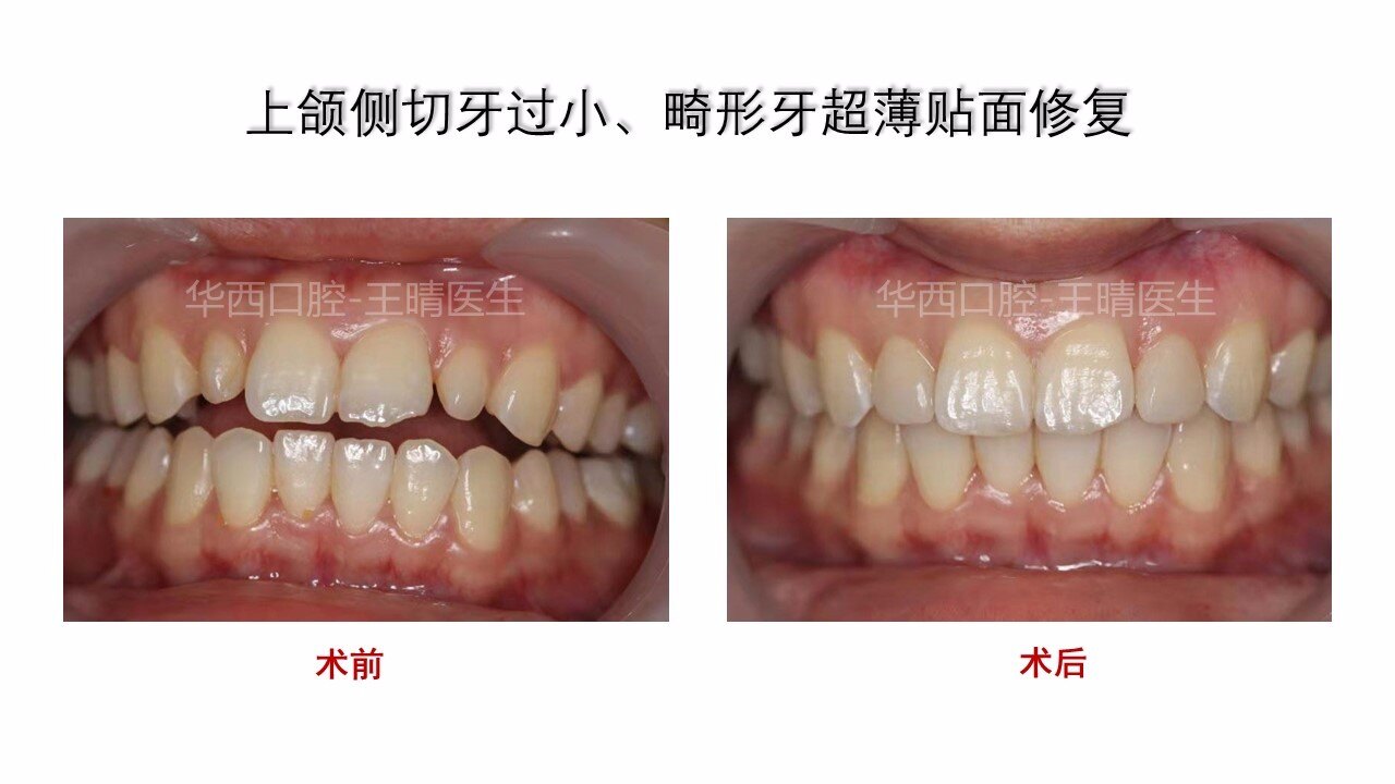 典型病例展示:上颌侧切牙过小,畸形牙超薄贴面修复 