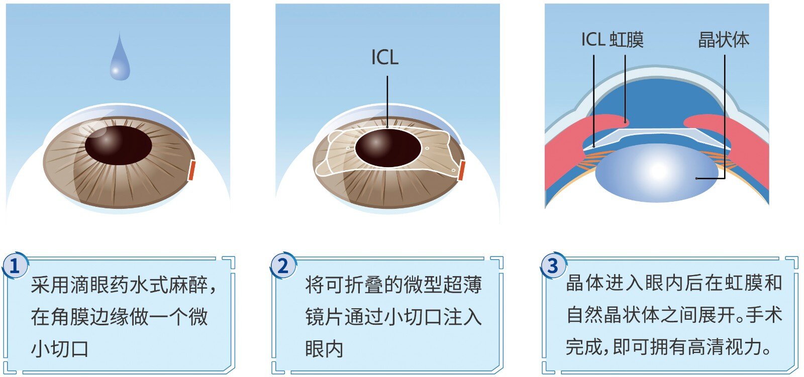 近视手术的选择 看这篇就够了 近视眼手术