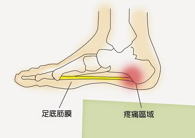 下面的图给出了常见痛点的分布足底筋膜炎通常会引起尖锐的刺痛