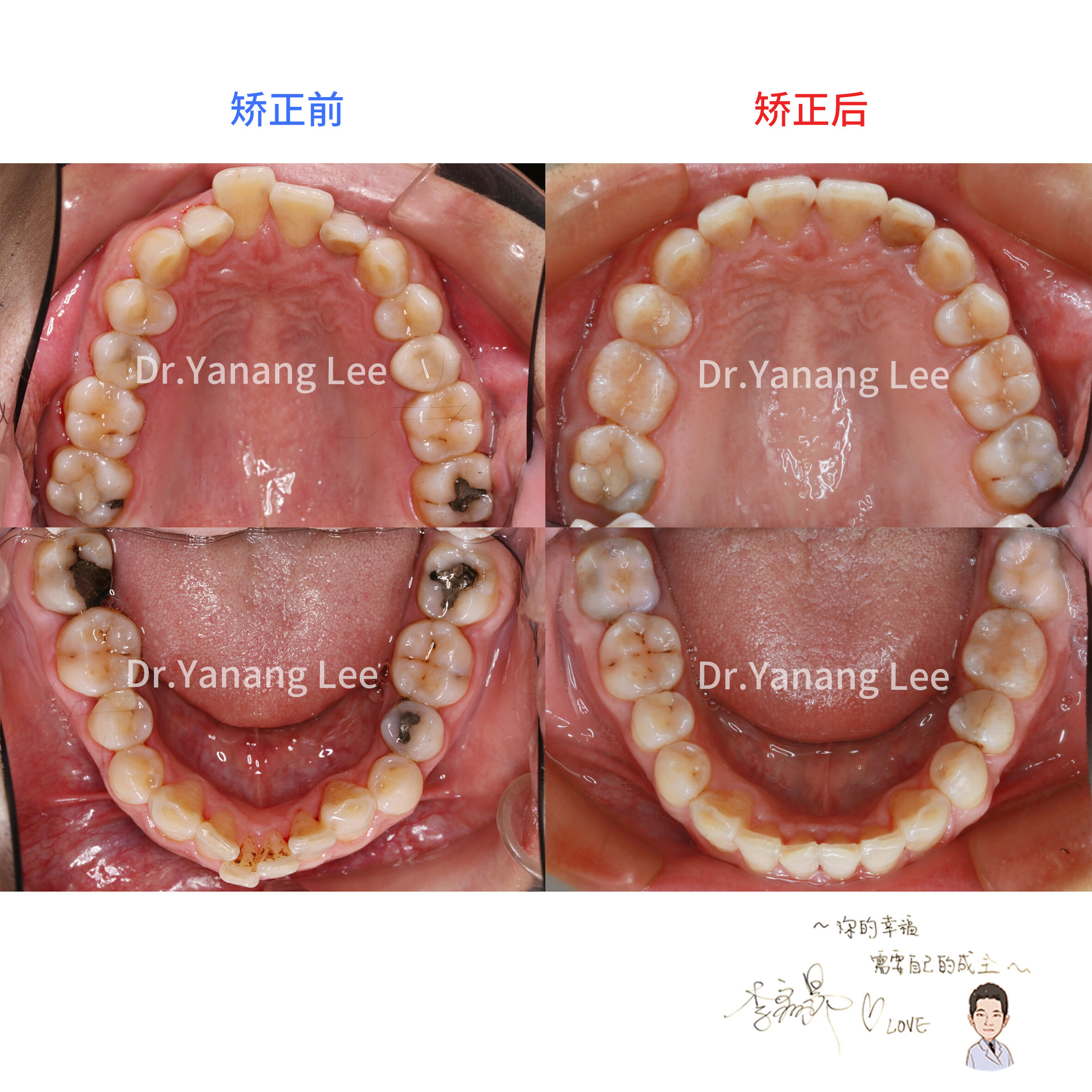 【隐适美改善深覆颌 深覆盖的矫正案例】