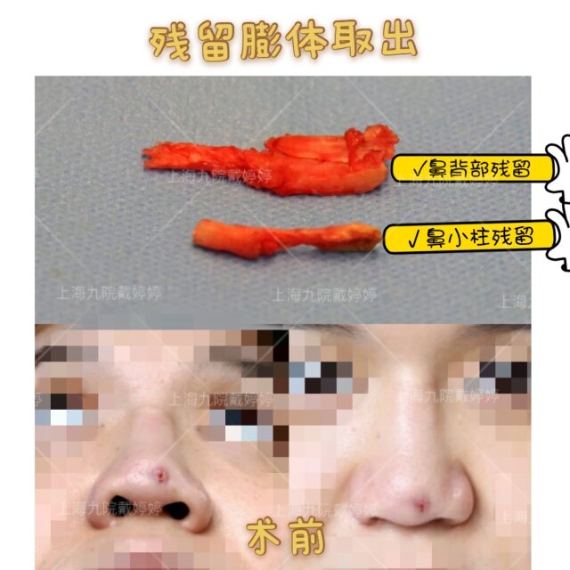 鼻修复残留膨体取出病例手术处理要点 - 好大夫在线