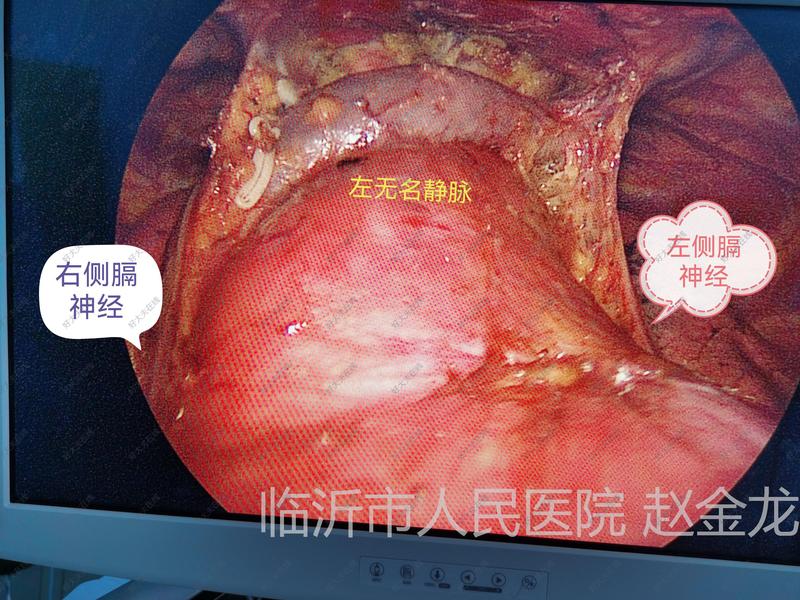 剑突下胸腺瘤扩大切除_胸腺瘤 - 好大夫在线