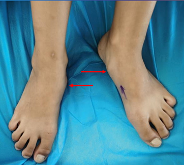 副舟骨疼痛综合征主要表现包括脚痛,可单侧也可双侧发病,疼痛的部位