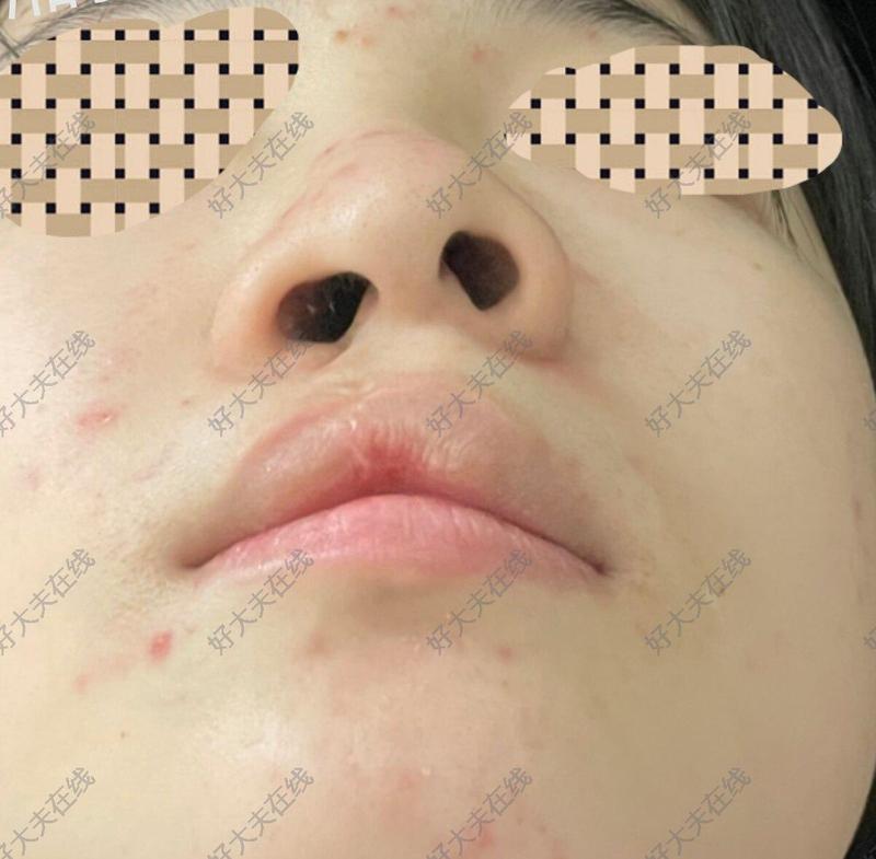 唇鼻畸形_唇腭裂 - 好大夫在线