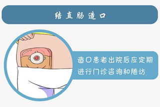 战胜病魔,正常生活--直肠癌低位保肛术介绍_直肠癌_直肠癌治疗方式