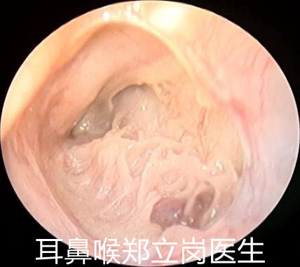 兒童鼓膜大穿孔耳內鏡微創手術可解決