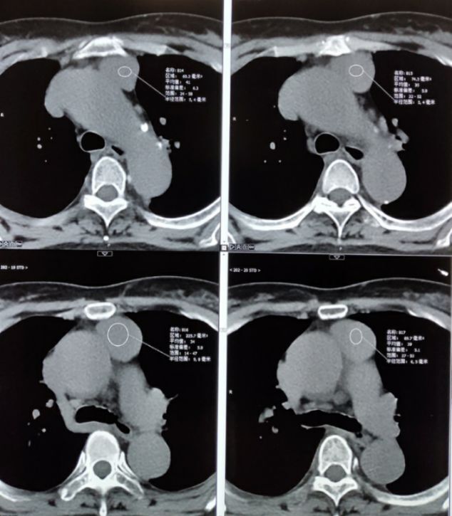 侵袭性胸腺瘤图片