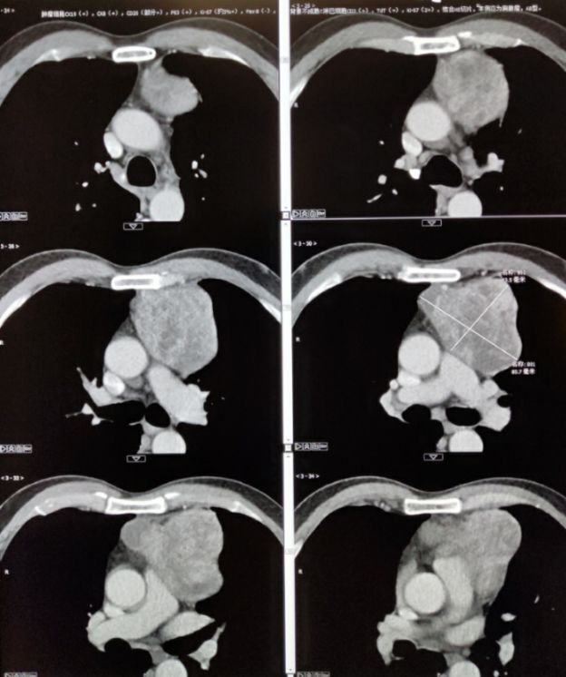 胸腺瘤ct表现图片