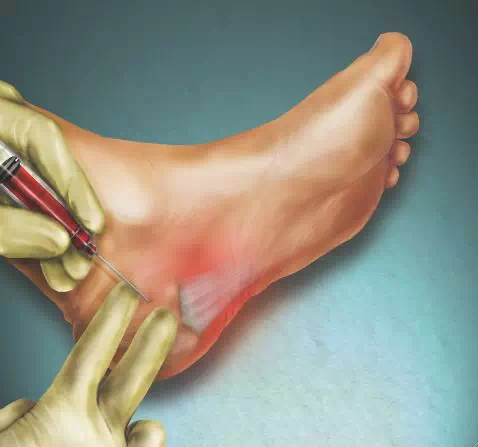 足底筋膜炎 治疗方法图片