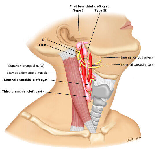 Branchialcleftcysts.jpg