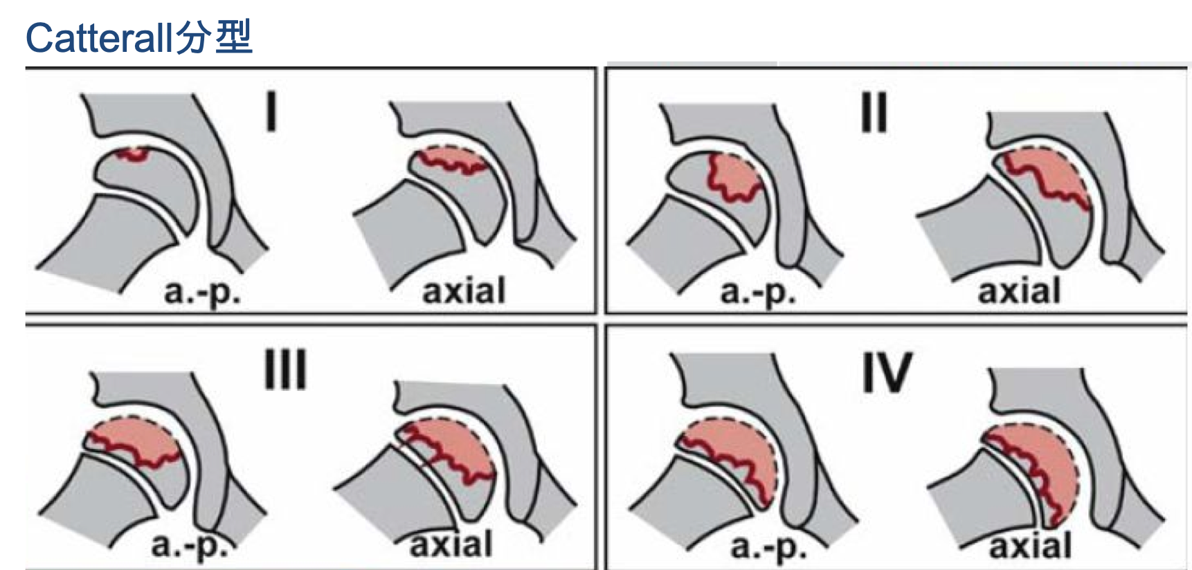 perthes 病科普系列之六:perthes病治疗结果能预测吗?