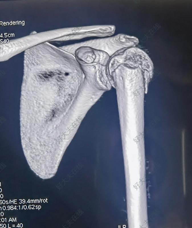 肱骨近端骨骺滑脱