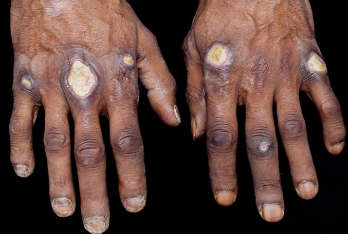 mda5型皮肌炎最新10问_皮肌炎_介绍_治疗方式 - 好大夫在线